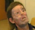 vidéo homme défiguré opération visage reconstruit os peau oeil nez bouche