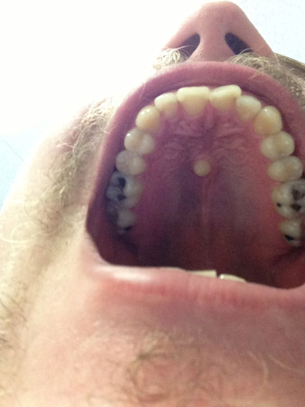 insolite dent surnumeraire
