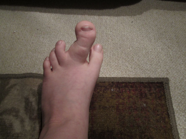 insolite doigt macrodactylie pied