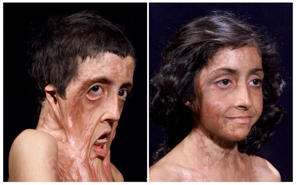 insolite brulure facial reconstruction visage