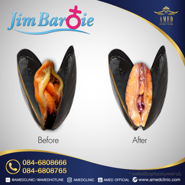 insolite chirurgie clinique esthetique moule pub thailande