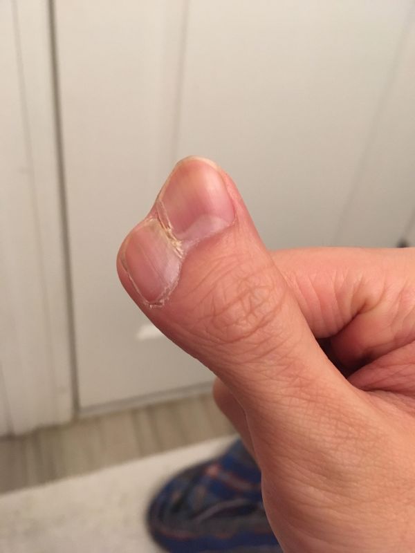 insolite deformation doigt double main pouce