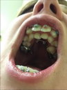 dentaire Dents de requin