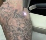 homme bras Effacer un tatouage au laser