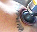 bras tatouage Effacer un tatouage avec une ponceuse