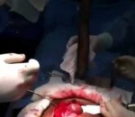 chirurgie operation Un poisson vivant dans les intestins