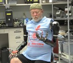 handicap prothese Un double amputé des bras avec des prothèses robotiques