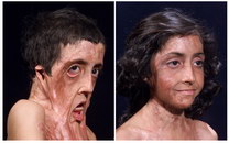 visage Reconstruction faciale d'une fille brulée