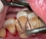 dentiste dent Détartrage de dents extrême