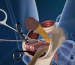 operation chirurgie Opération de changement de sexe en 3D