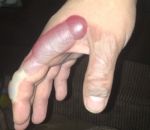 forme penis Une main brulée prend la forme d'un pénis