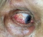 extraction medecin Un homme se fait retirer un ver parasite de l'oeil (Inde)