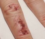 sang doigt 33 jours de cicatrisation en TimeLapse