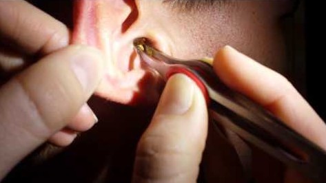 Un bouchon de cérumen dans l'oreille