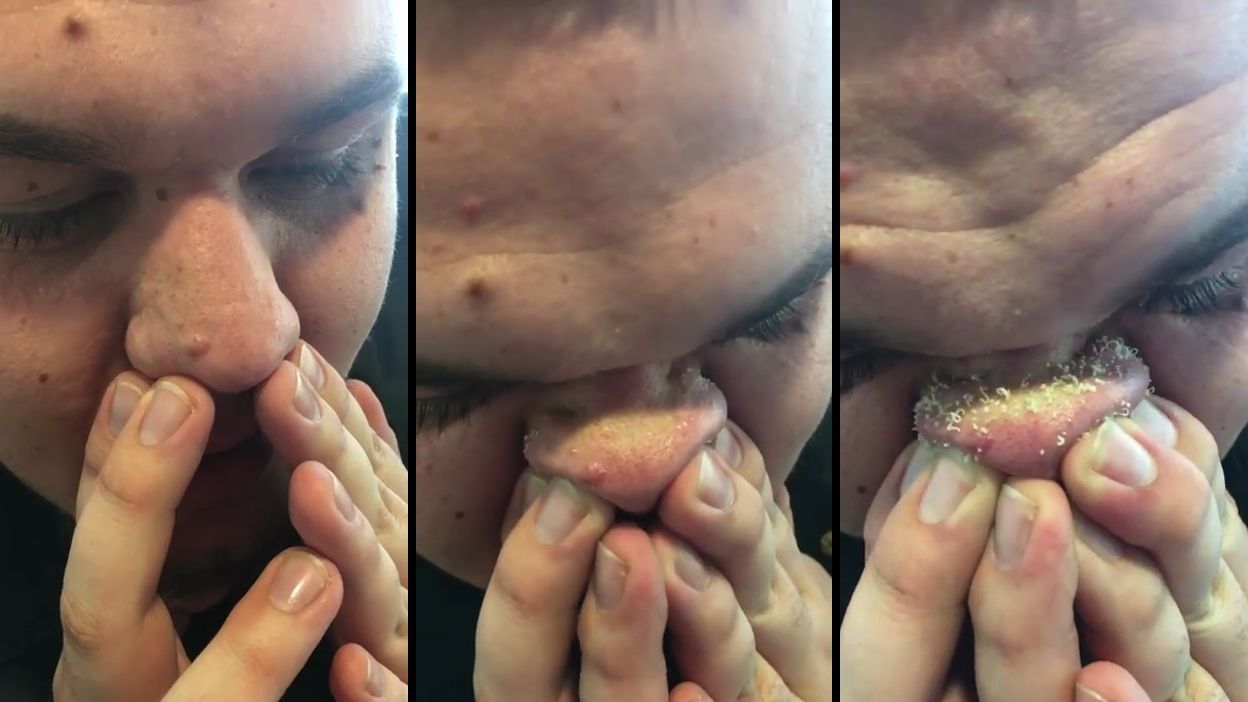 Une technique pour enlever les points noirs sur le nez