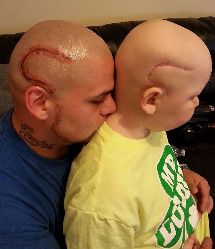 Un papa se tatoue la cicatrice de son fils atteint d'un cancer