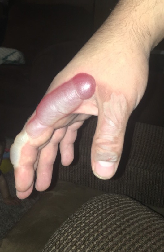 Une main brulée prend la forme d'un pénis