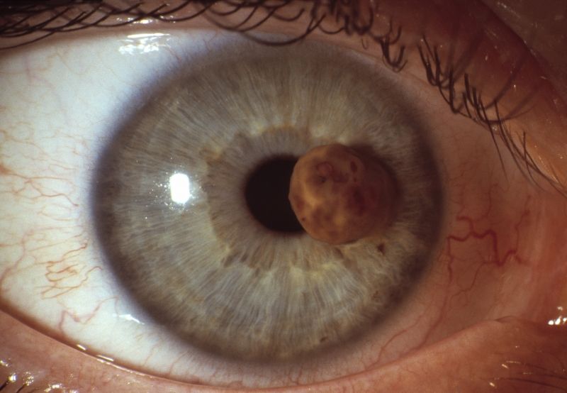 insolite cancer iris melanome oeil tumeur