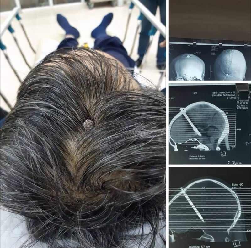 insolite  clou crane tete