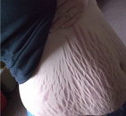 femme ventre Vergetures après une grossesse