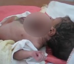 malformation bebe Bébé avec une ectopie cardiaque