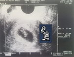 foetus Fœtus Koopa Troopa