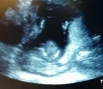 enceinte femme Une échographie montre un bébé frapper dans ses mains