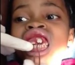 bouche Une fille de 10 ans les gencives infestées de larves