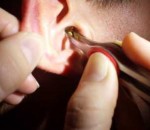 retirer Un bouchon de cérumen dans l'oreille